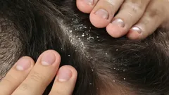 Shampoota ei tarvita: hyvästele hilse mausteen avulla, jota löytyy jokaisesta kodista